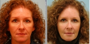 Facial Fat Transfer and Upper Blepharoplasty