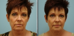 Facial Fat Transfer Texas