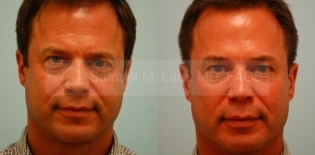 Fat Grafting for Men