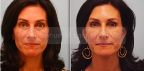 Full Facial Fat Transfer