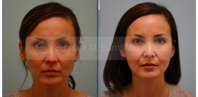 Fat Grafting and Silicone Lip Enhancement