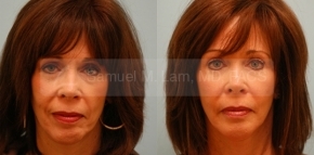 Facial Fat Transfer