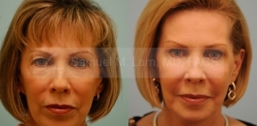 Fat Transfer and Upper Blepharoplasty