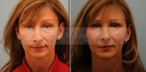Full Facial Fat Transfer