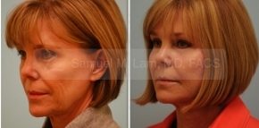 Fat Transfer