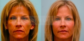 Facial Fat Transfer