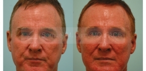 Facial Fat Transfer