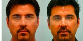Facial Fat Transfer