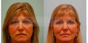 Facial Fat Transfer