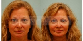 Facial Fat Transfer