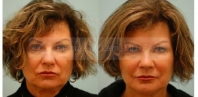Facial Fat Transfer