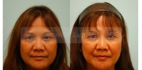 Facial Fat Transfer