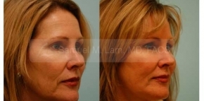 Facial Fat Transfer