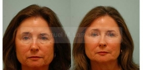 Facial Fat Transfer