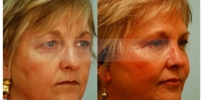 Facial Fat Transfer