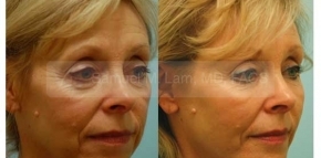 Facial Fat Transfer