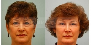 Facial Fat Transfer