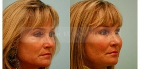 Facial Fat Transfer
