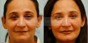 Facial Fat Transfer