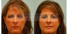 Facial Fat Transfer