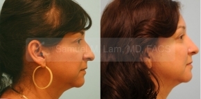 Fat Transfer (and Rhinoplasty)