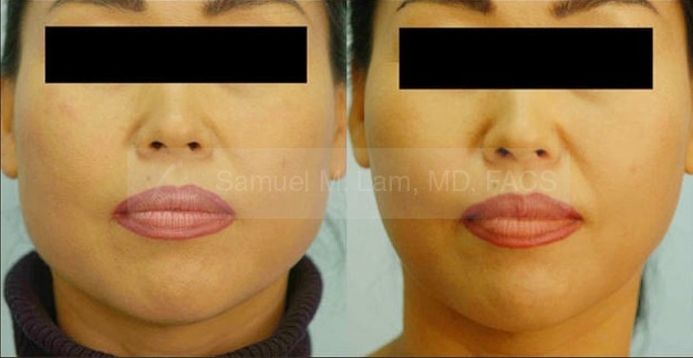 Asian Jaw Reduction Photos