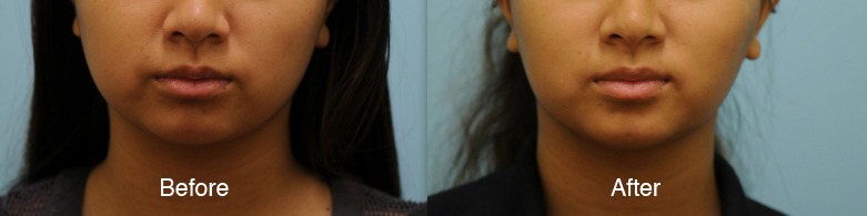 Asian Jaw Reduction Photos