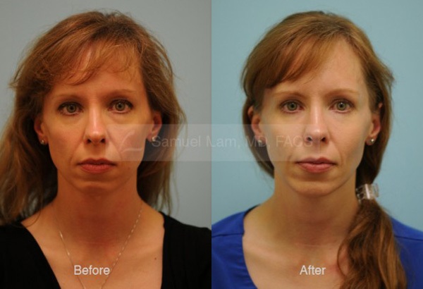 Cheek Augmentation Result Dallas