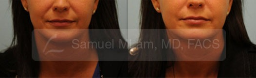 Juvederm Ultra Photos