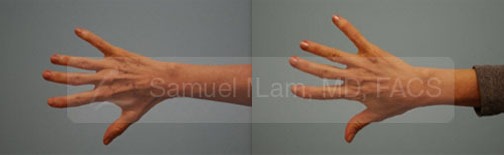 Juvederm Ultra Photos