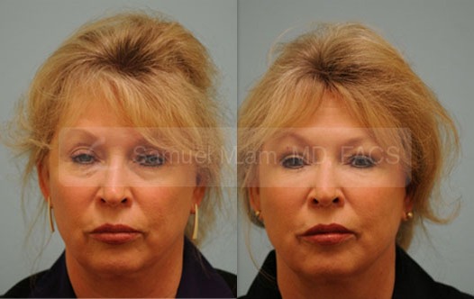 Juvederm Ultra Photos
