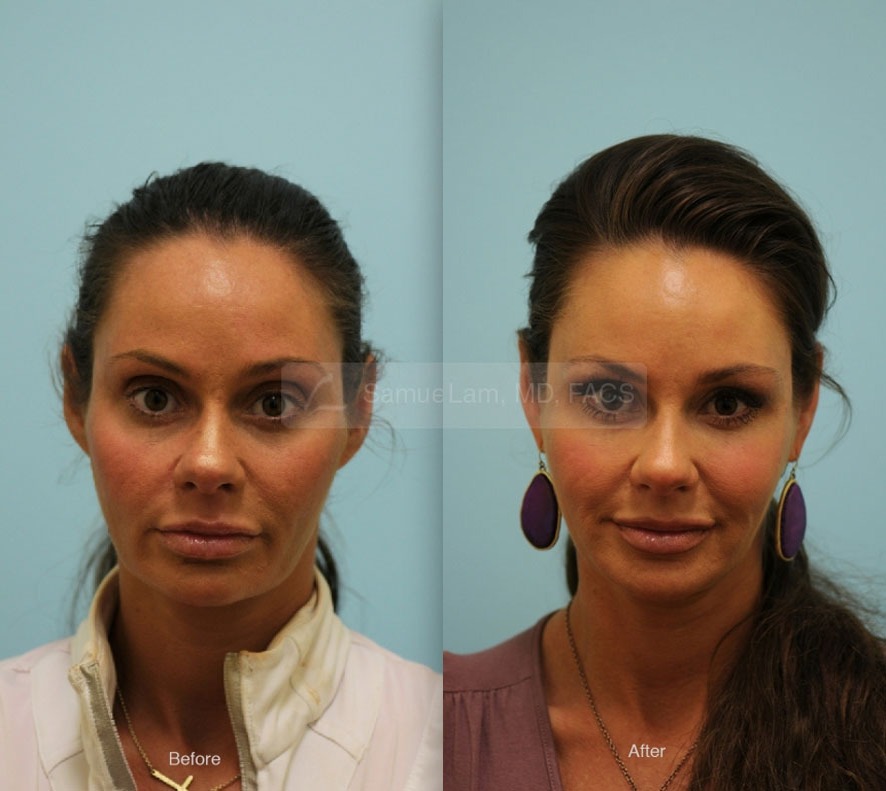 Juvederm Ultra Photos