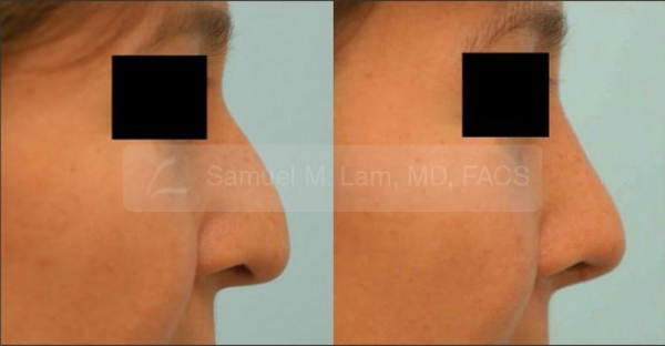 Caucasian Rhinoplasty Photos
