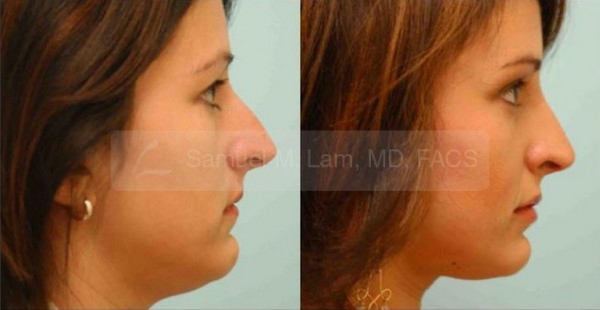 Tension Nose Rhinoplasty Photos
