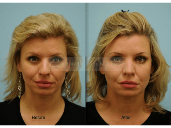 Caucasian Rhinoplasty Photos