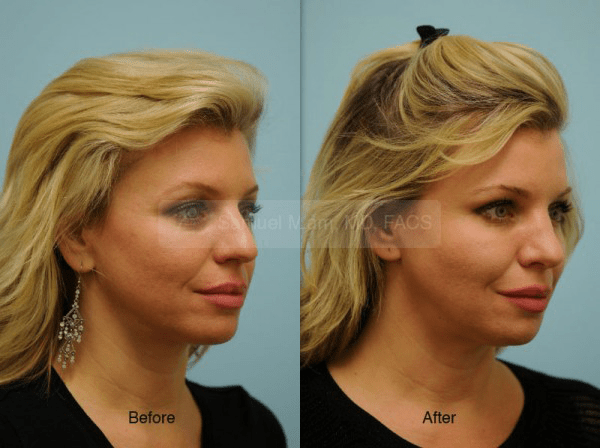 Caucasian Rhinoplasty Photos
