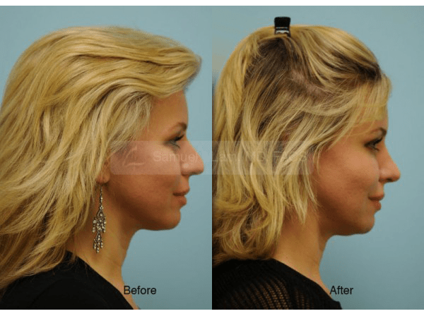 Caucasian Rhinoplasty Photos