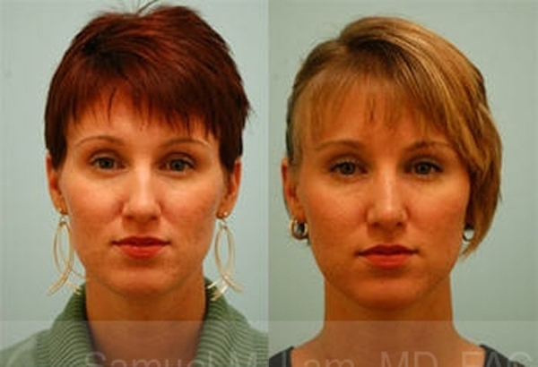 Revision Rhinoplasty Photos