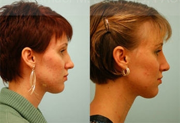 Revision Rhinoplasty Photos