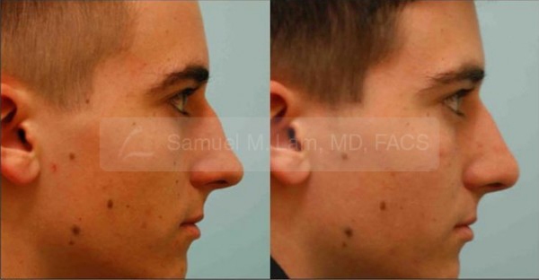 Revision Rhinoplasty Photos