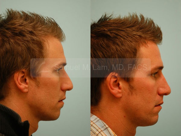 Revision Rhinoplasty Photos