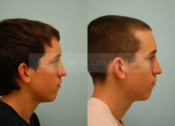 Reconstructive Rhinoplasty Photos