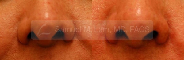 Revision Rhinoplasty Photos