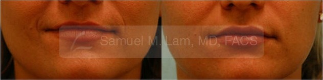 Lip Augmentation Photos