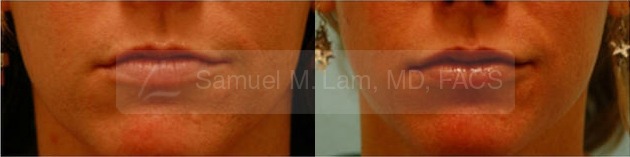 Lip Augmentation Photos