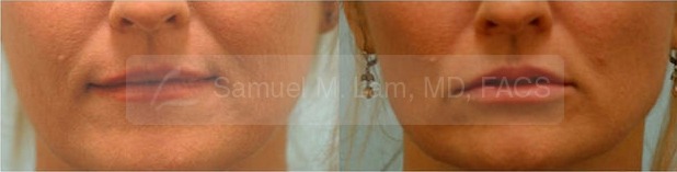 Lip Augmentation Photos