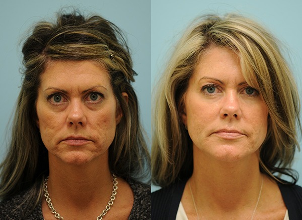 Juvederm Ultra Photos