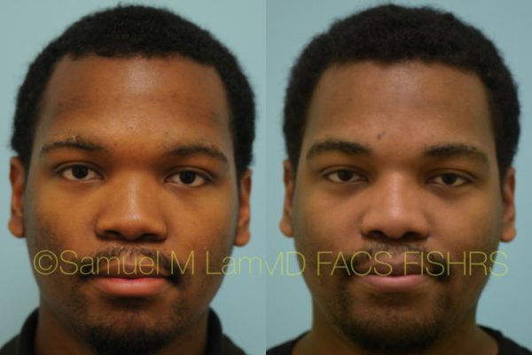 Reconstructive Rhinoplasty Photos