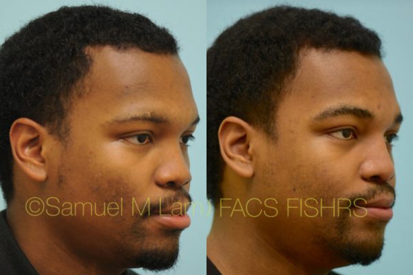 Reconstructive Rhinoplasty Photos