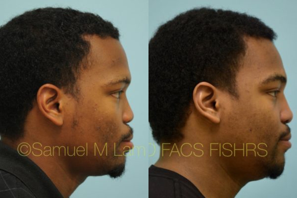 Reconstructive Rhinoplasty Photos